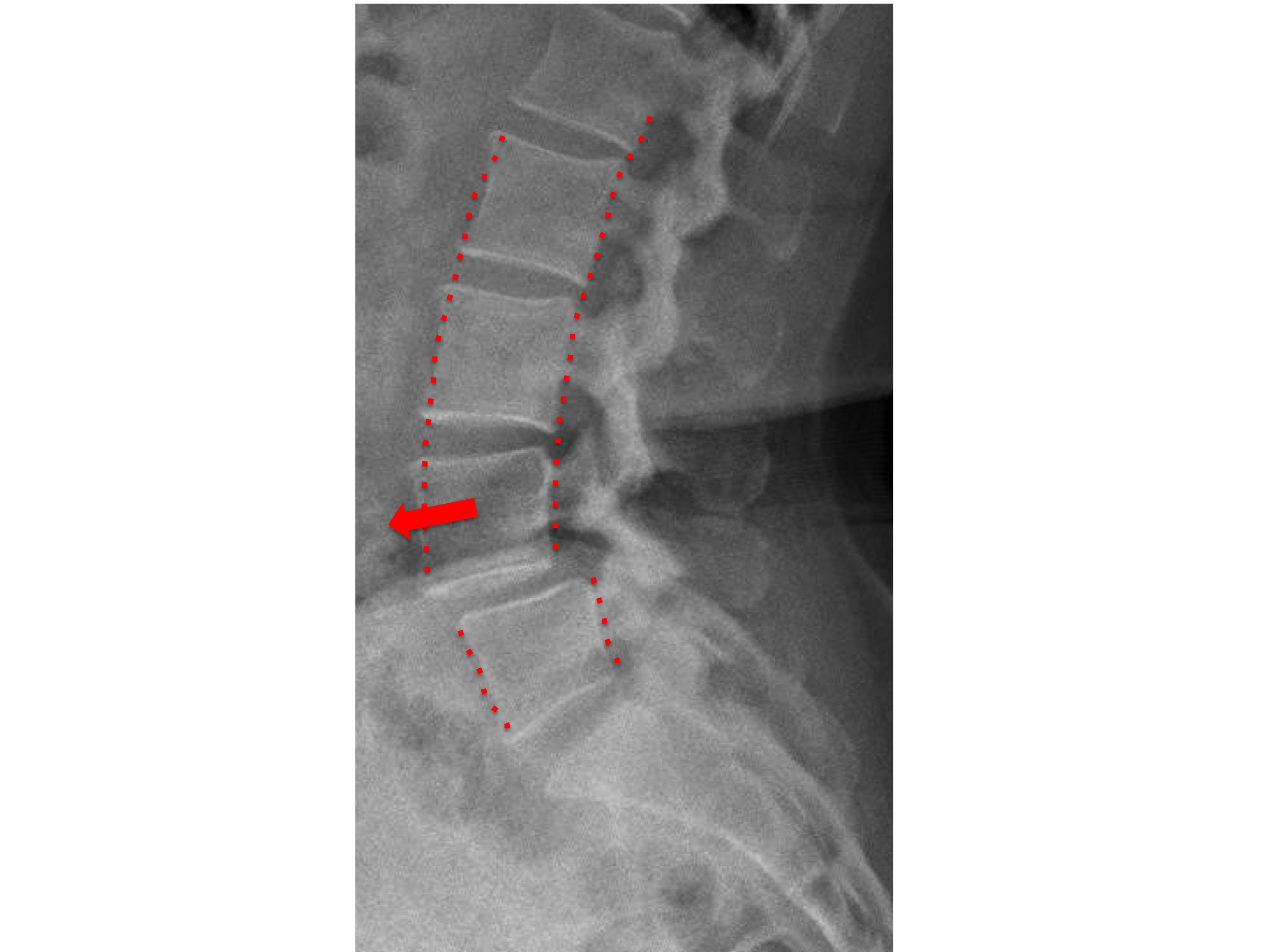 Exame de imagem da coluna vertebral para a confirmação do diagnóstico de espondilolistese. É possível observar na ressonância magnética a indicação da localização do problema. Exame de imagem da coluna vertebral para a confirmação do diagnóstico de espondilolistese. É possível observar na ressonância magnética a indicação da localização do problema.